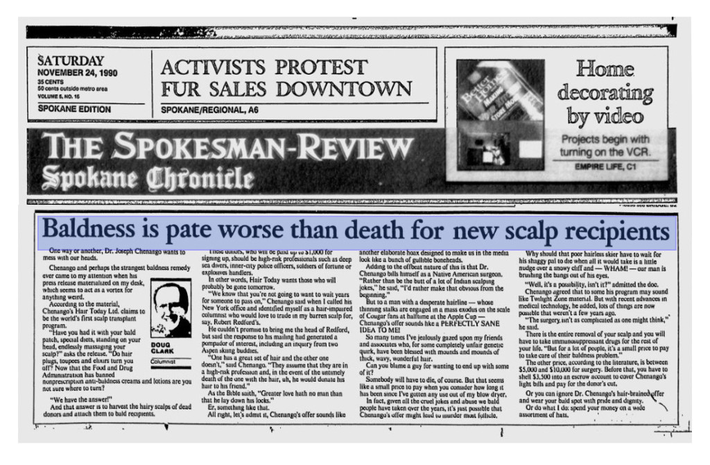Baldness is pate worse than death for new scalp recipients, by Doug Clark, Spokesman-Review Spokane Chronicle, November 24, 1990
